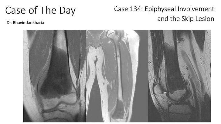 COD 134 - Epiphyseal Involvement and The Skip Lesion