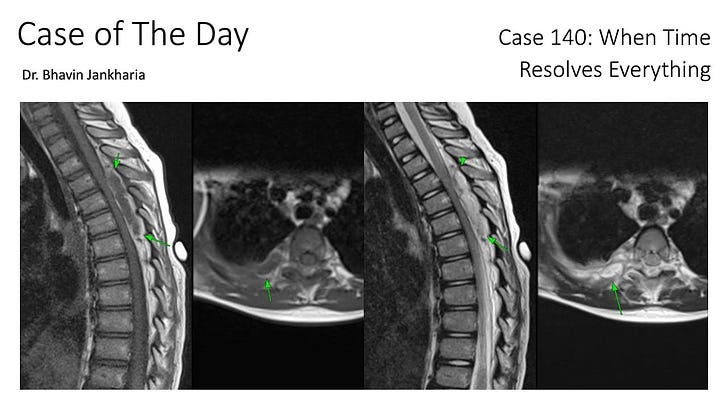 COD 140 - Spontaneous Epidural Hematoma Resolving Spontaneously 