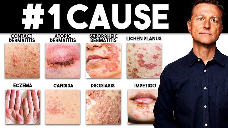 Skin disorders and Vitamin D Deficiency